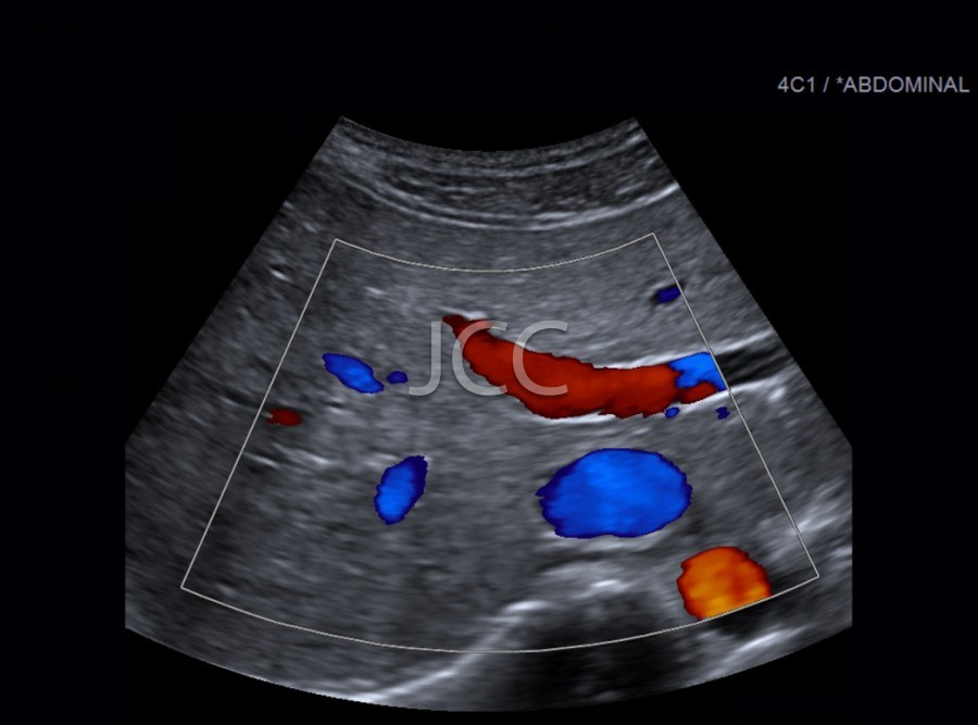 jcc_eco_abdominal_doppler_3.jpg
